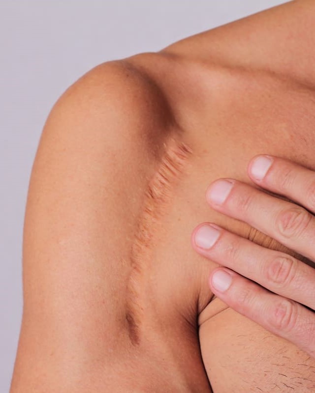 terapia manualna blizn